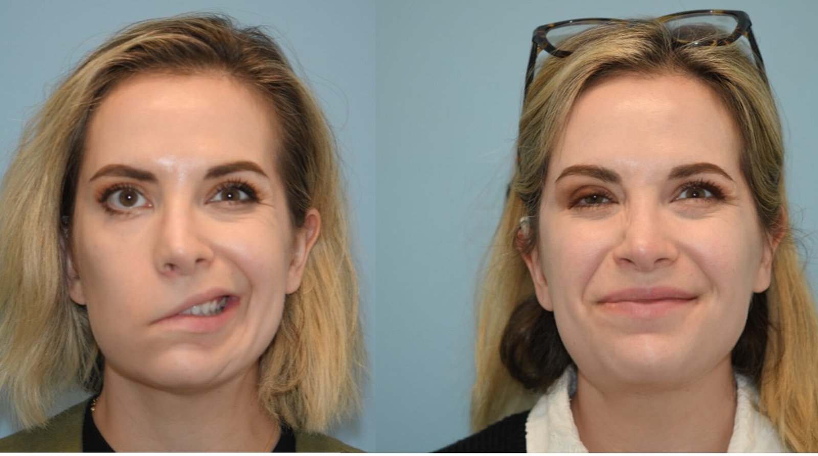 Facial Reanimation: відновлення функції обличчя при паралічі лицевого нерва