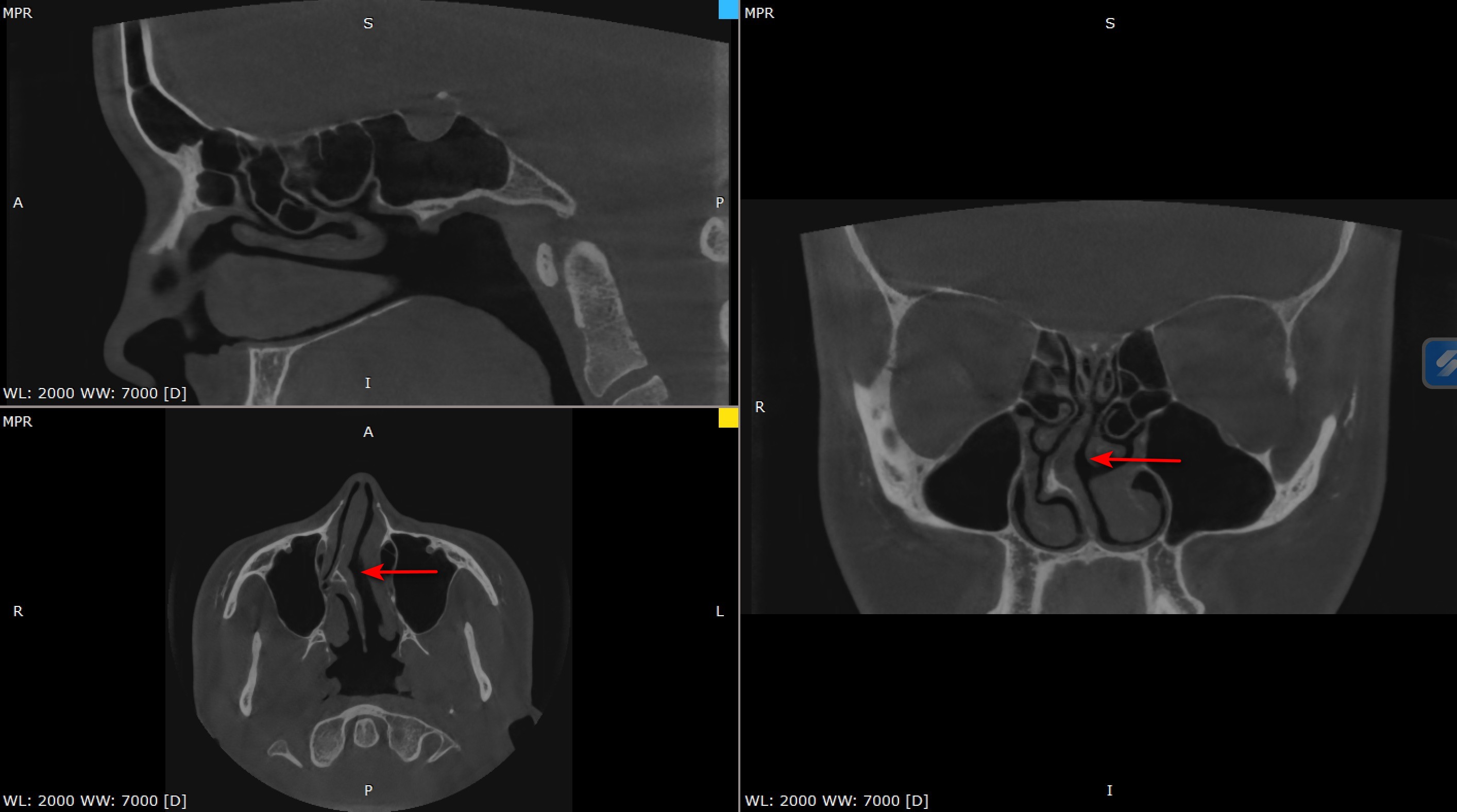 Септопластика Львів: операція при викривленні перегородки (дихайте вільно) | Чи потрібна операція?