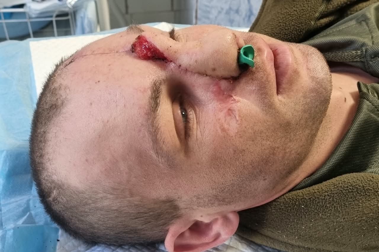 Paramedian Forehead Flap: золотий стандарт реконструкції носа