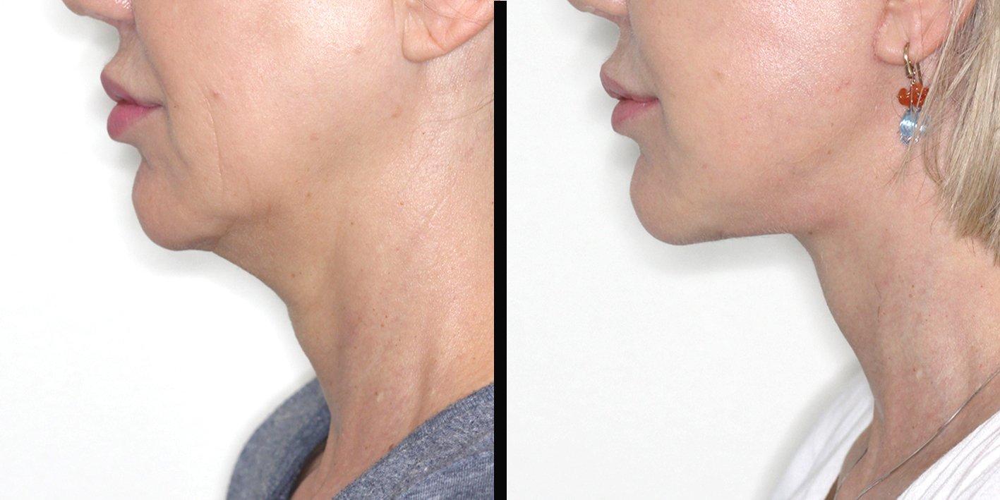 Deep Plane Facelift та підтяжка шиї: чи потрібно робити разом? Дуже популярна тема. Розкрити: •	плат