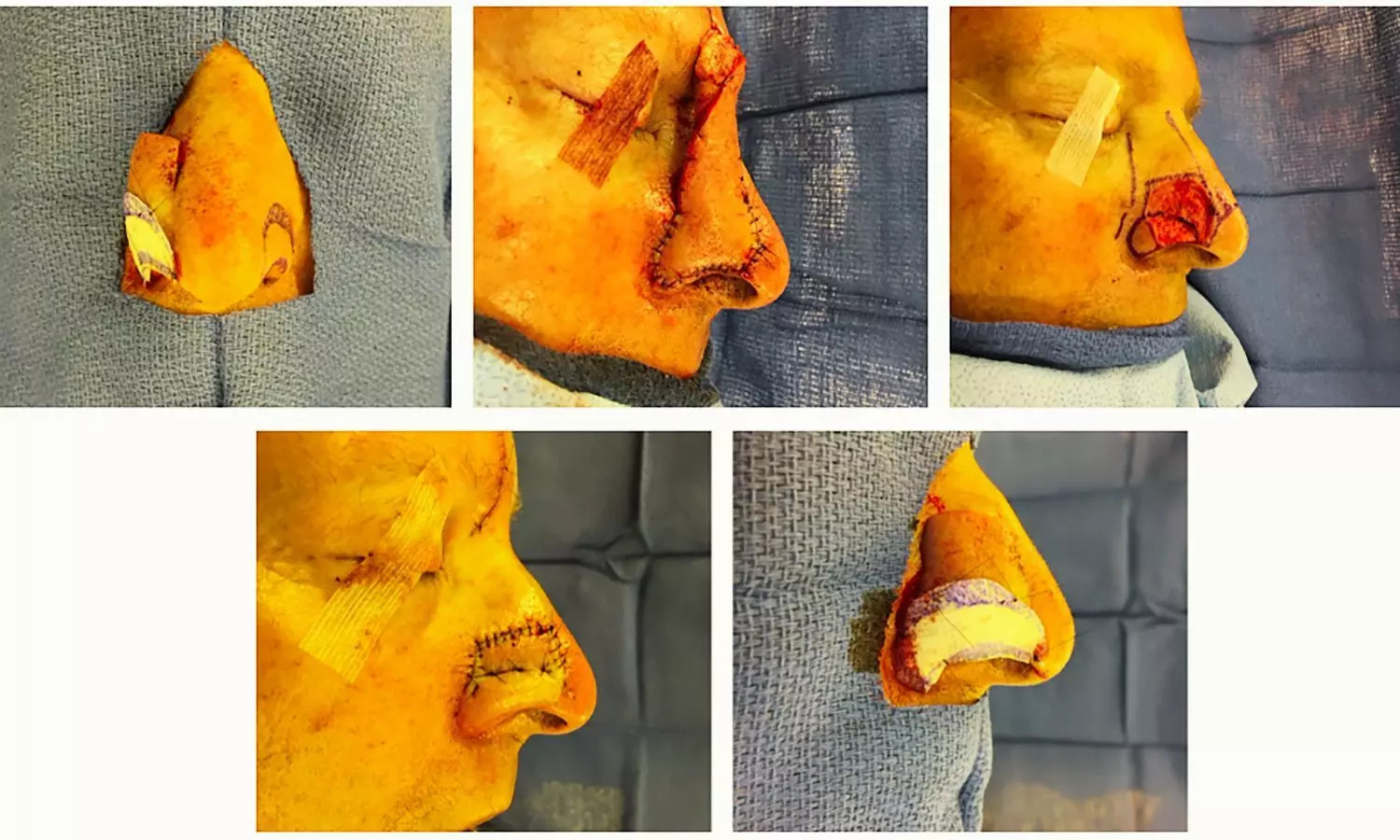 Forehead Flap Reconstruction: золотий стандарт реконструкції складних дефектів носа