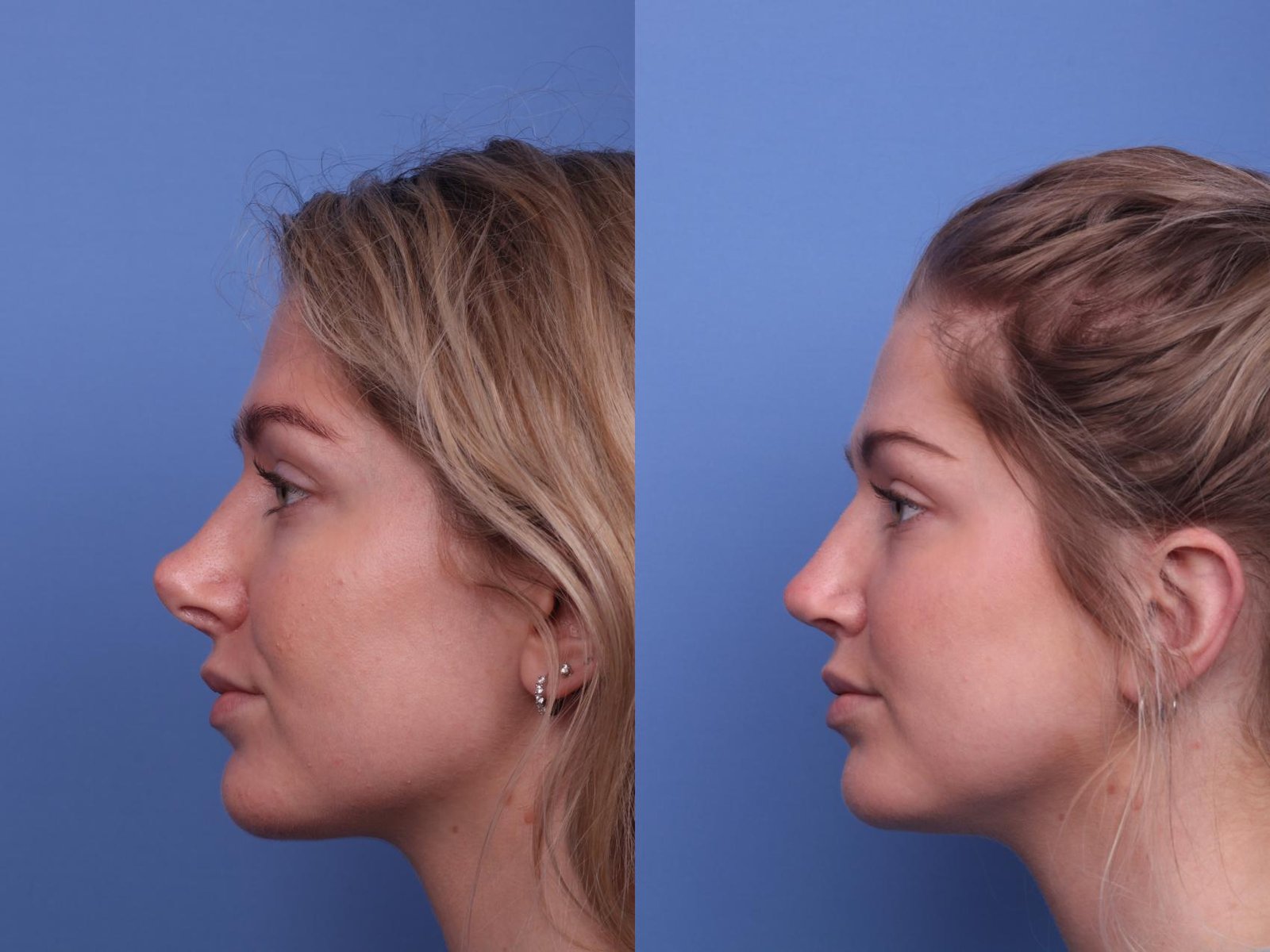 Повторна ринопластика (Revision Rhinoplasty) у Львові | Віталій Панченко