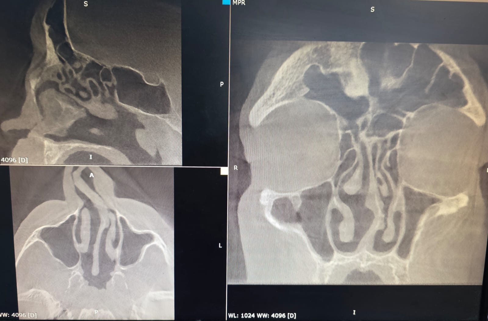 Nasal Valve Collapse (Колапс носового клапана): сучасна діагностика та функціональна риносептопласти